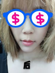 点击看大图 体验后-禾美嘉医疗美容
