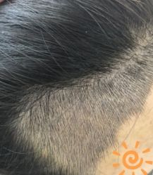 -大麦微针植发丨全国连锁