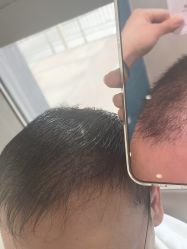 -碧莲盛·不剃发植发