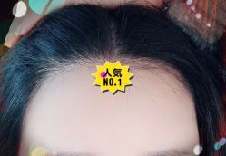 -大麦微针植发全国连锁