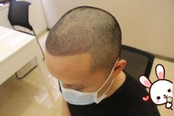 -大麦微针植发丨全国连锁