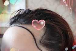 -大麦微针植发全国连锁