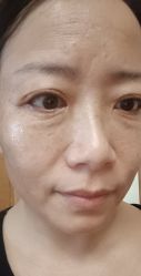 -爱莎扁平疣·汗管瘤·斑痣中心