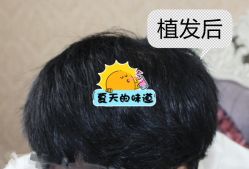 -大麦微针植发全国连锁