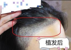 -大麦微针植发全国连锁