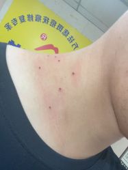 -北京美痣堂古方祛痣斑疣瘊