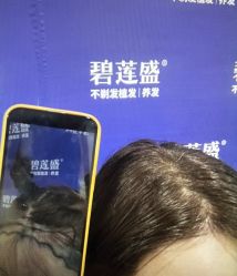 -碧莲盛·不剃发植发