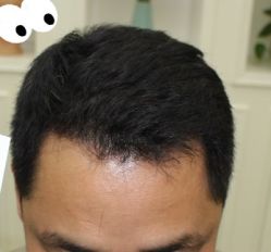 -大麦微针植发丨全国连锁