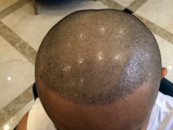 -碧莲盛·不剃发植发