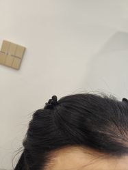 -碧莲盛·不剃发植发