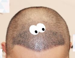 -大麦微针植发全国连锁