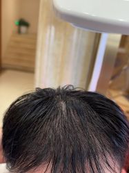 -碧莲盛·不剃发植发