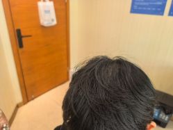 -碧莲盛·不剃发植发