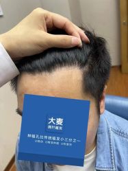 -大麦微针植发全国连锁