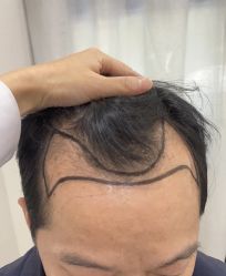 体验前-大麦微针植发全国连锁