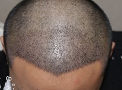 -大麦微针植发丨全国连锁