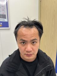 -大麦微针植发全国连锁
