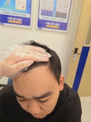 -大麦微针植发全国连锁