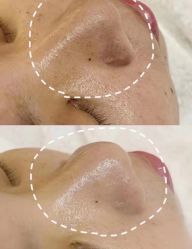 体验前-凡碧诗毛孔清洁收细