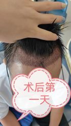 体验后-大麦微针植发全国连锁