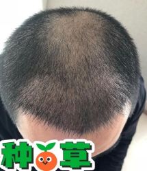 -大麦微针植发丨全国连锁