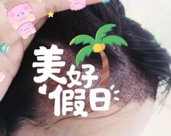 -大麦微针植发全国连锁