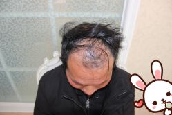 -大麦微针植发丨全国连锁