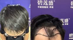 -碧莲盛·不剃发植发