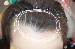 -大麦微针植发全国连锁