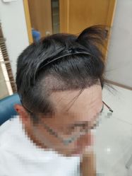 -大麦微针植发丨全国连锁