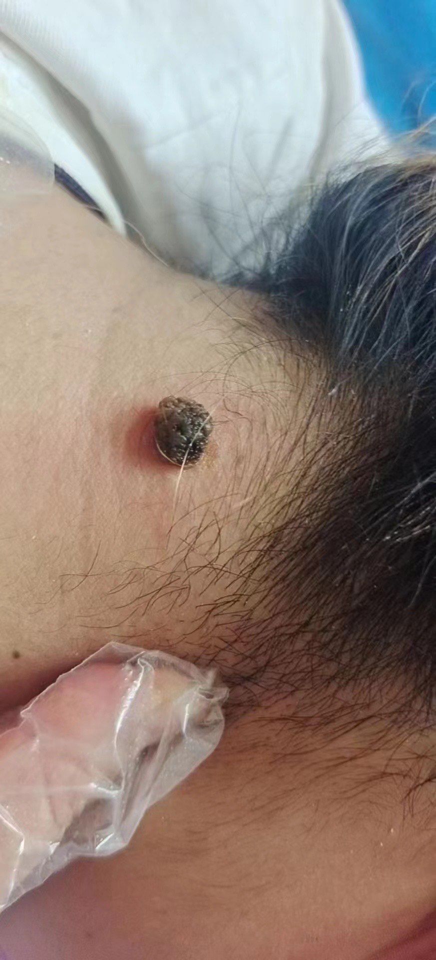 大肉痣一次性根除