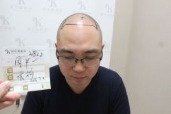 点击看大图 -大麦微针植发丨全国连锁