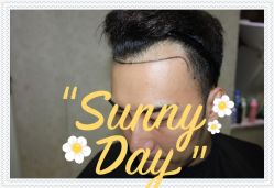 -大麦微针植发全国连锁