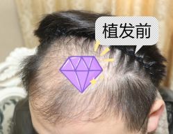 -大麦微针植发全国连锁