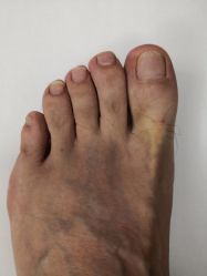 -派恩宜灰指甲鸡眼嵌甲手足癣