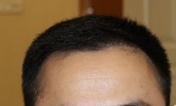 -大麦微针植发丨全国连锁