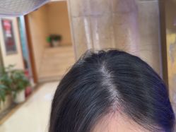 -碧莲盛·不剃发植发