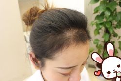 -大麦微针植发丨全国连锁