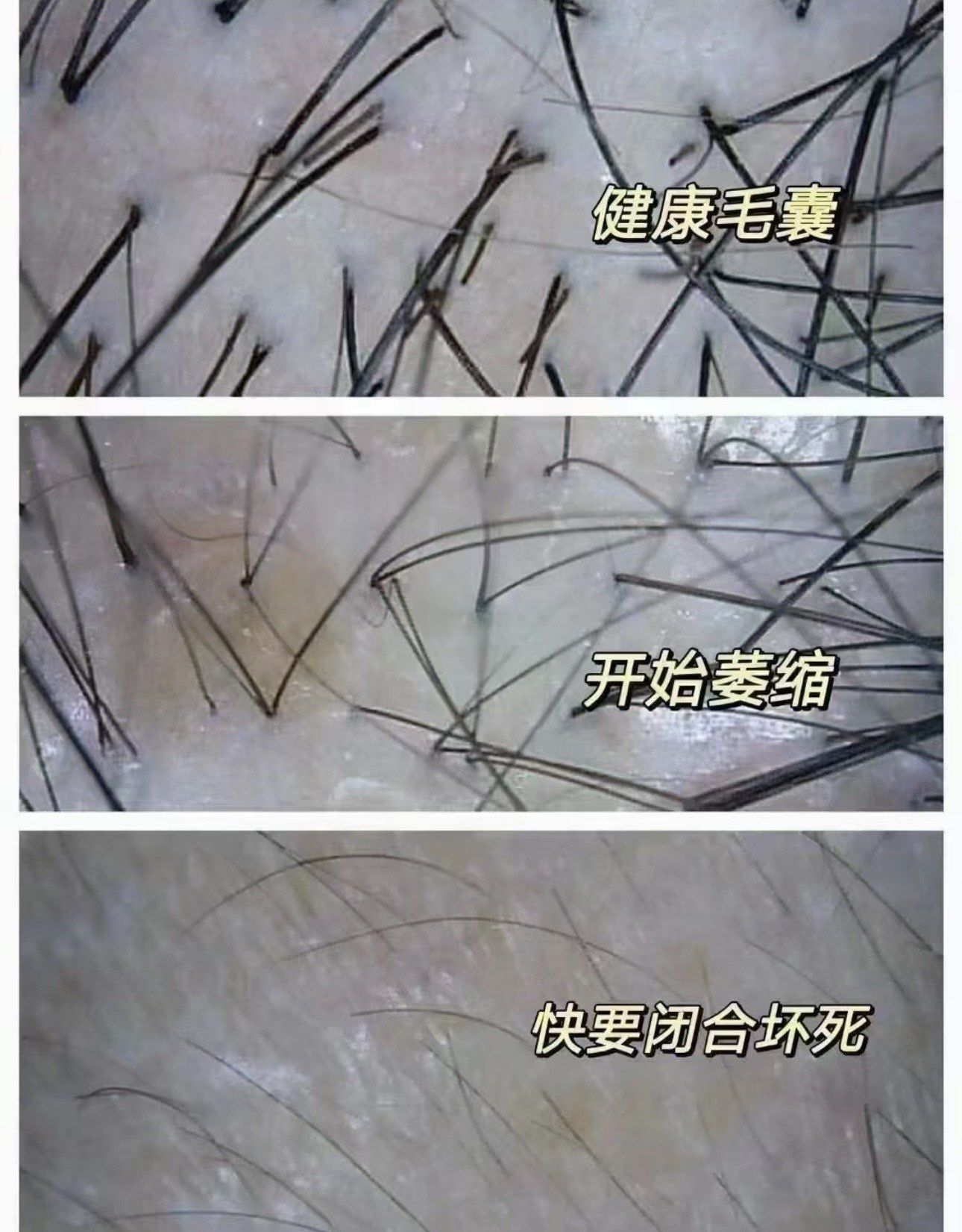 手把手教你远离毛囊炎