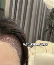 -大麦微针植发丨全国连锁
