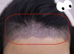 -大麦微针植发全国连锁