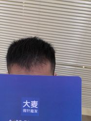 体验后-大麦微针植发丨全国连锁