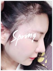 体验后-大麦微针植发全国连锁