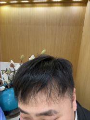 -大麦微针植发丨全国连锁