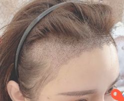 -大麦微针植发丨全国连锁