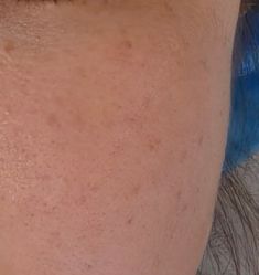 体验前-深圳米兰柏羽医疗美容医院