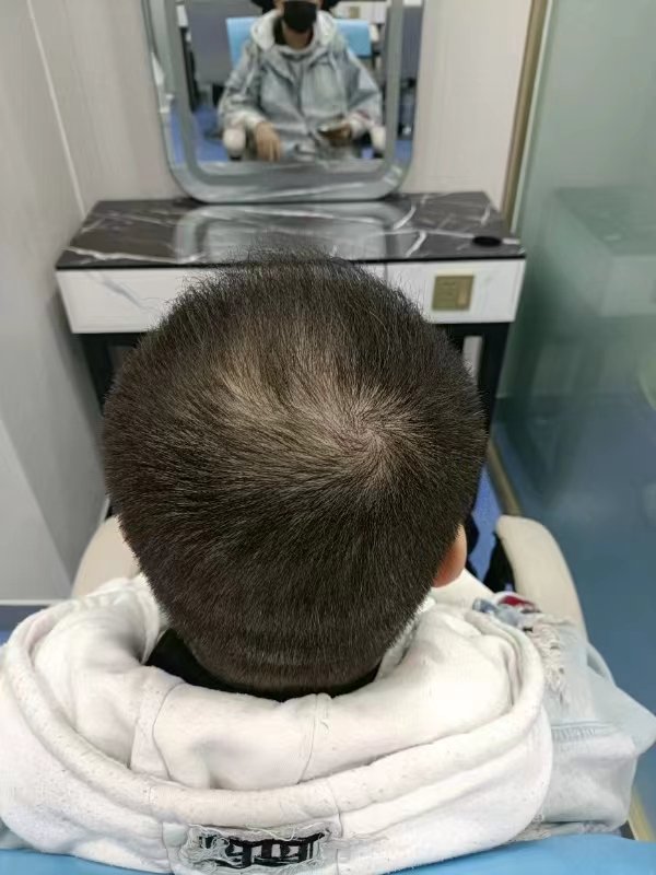 植发两个月植发区还是痒(植发两个月后头皮痒怎么办)