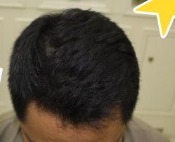 -大麦微针植发丨全国连锁