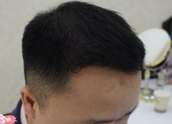 -大麦微针植发丨全国连锁