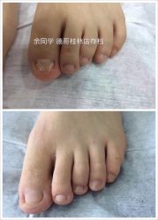 -德哥灰指甲脚气甲沟炎跖疣护理